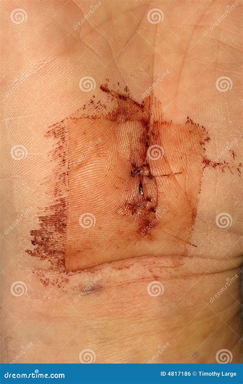Operation Scar Of Achilles Tendon Rupture And Crutchs Royalty-Free Stock Photography ...