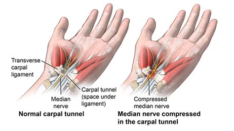 Natural Remedies for Carpal Tunnel Syndrome | HealthFirst Spine & Wellness