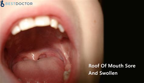 What Does Roof Of Mouth Sore And Swollen Mean? - Get Second Opinion Now