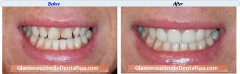 Before and After Dental Smile Gallery - Glamorous Smile Dental SPA