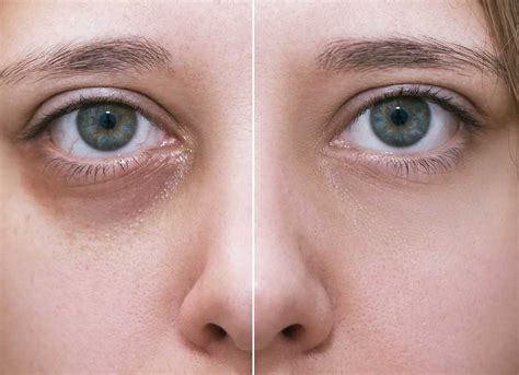 Panda Eyes: Dark Circles Treatment In Karachi | Dr. Fehmida Arif