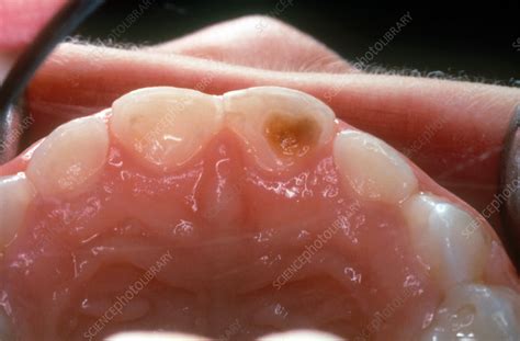 Baby Bottle Tooth Decay - Stock Image - C039/3008 - Science Photo Library