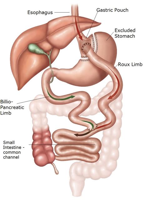 Gastric Bypass Surgery Procedure: Rapid Clinical Way