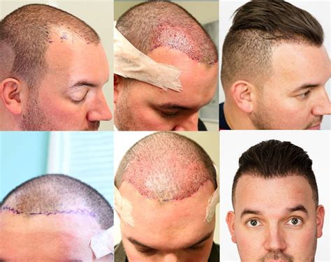 Receding hairline Transplantation surgery, FUE Hair transplant before and after