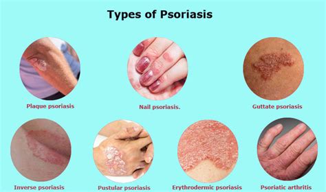 Psoriasis Rash Pictures Symptoms