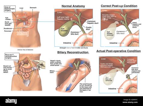 Laparoscopic Cholecystectomy Anatomy