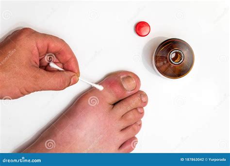 Gout Big Toe Treatment