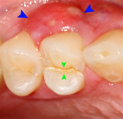 periodontal abscess | DentalDisaster.com