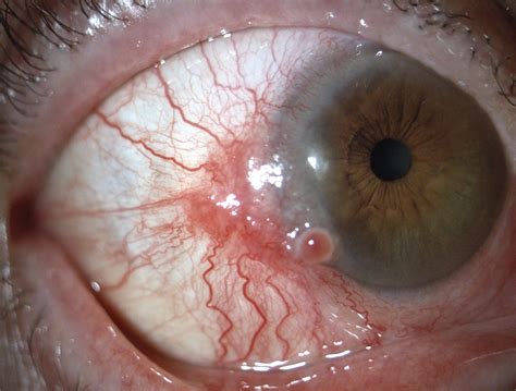 Conjunctival Squamous-Cell Carcinoma | NEJM