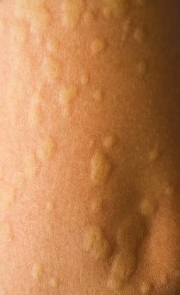 Cold Urticaria Welts on Skin Due to Cold Temperature Could be Hives | Woodlands TX