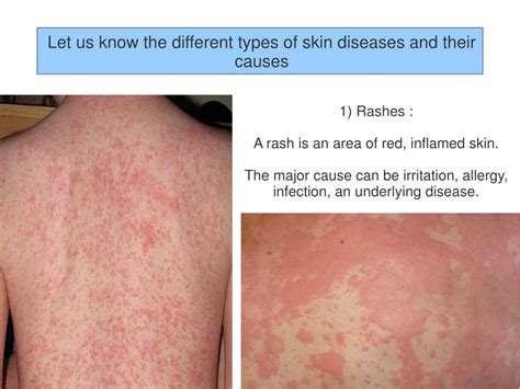 4 Types Of Diseases