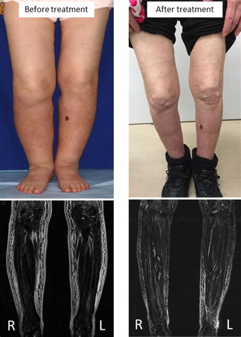 An uncommon cause of leg oedema | BMJ Case Reports