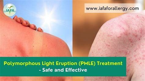 Polymorphous Light Eruption (PMLE) Treatment – Safe and Effective