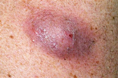 Infected Sebaceous Cyst On Back Photograph by Dr P. Marazzi/science Photo Library