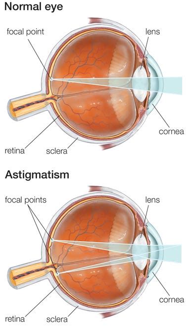 Astigmatism - Lyndia Benefield