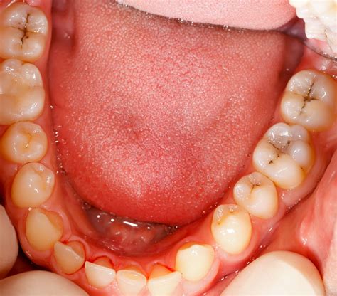 Cavities In Back Teeth