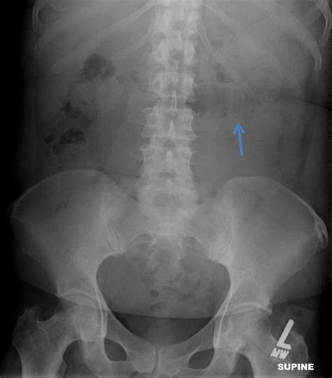 (left): 51 year old female with a posterior rectus sheath hernia.... | Download Scientific Diagram