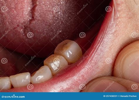 Crowned Teeth. Preparation of Teeth in Dentistry for the Installation of Prostheses. Macro Stock ...