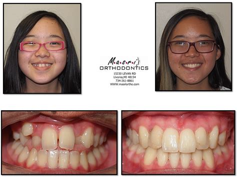 Open Bite Jaw Surgery & Braces Before and After Treatment