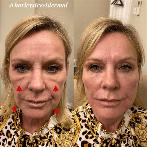 Marionette Lines Treatment in London | Harley Street Dermal