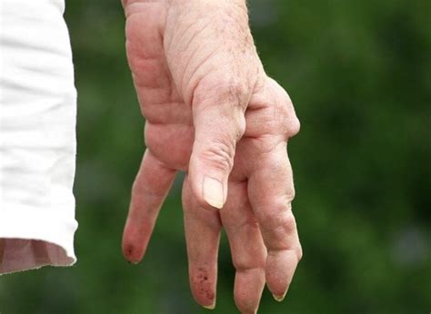 Understanding Nodules in Fingers Rheumatoid Arthritis
