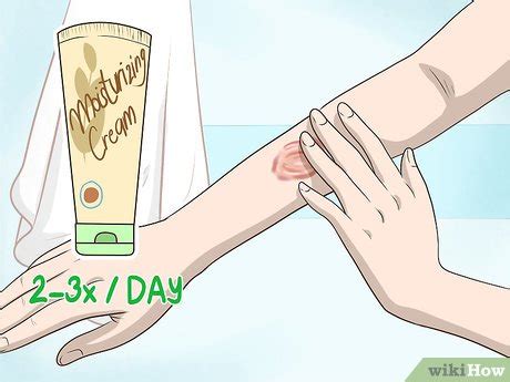 3 Ways to Get Rid of Burn Scars - wikiHow