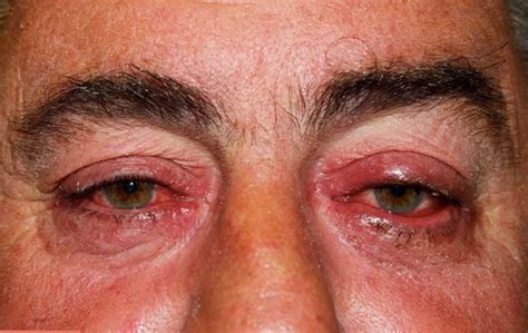 Eyelid Redness Causes, Symptoms, Inflamed, Dry Itchy Swollen Red ...