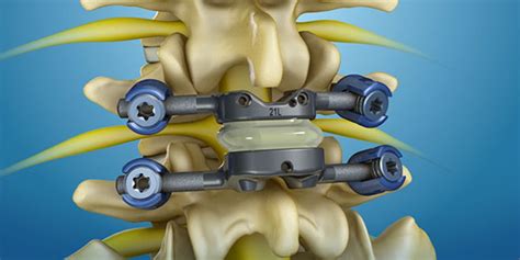 Spinal Stenosis Treatment | TOPS™ System by Premia Spine