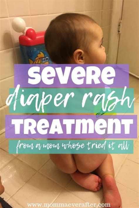 Severe Diaper Rash Treatment (from a mom whose tried it all!) - Momma Ever After