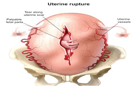 Rising uterine rupture endangers pregnant women