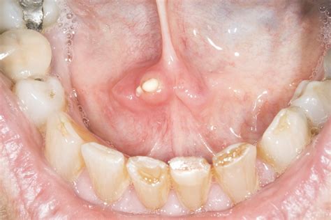 Salivary gland stones - NHS