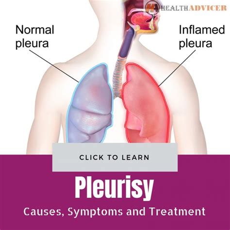 Pleurisy : Causes, Picture, Symptoms And Treatment