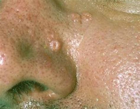 Sebaceous Glands - Pictures, Function, Types, Location - HubPages