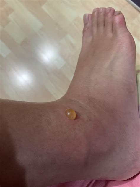 A shiny pebble - blister after a mosquito bite : r/popping