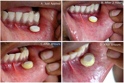 Medical Attention: THE BUCCAL ROUTE OF DRUG ADMINISTRATION