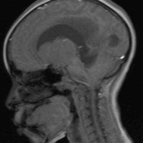 (PDF) Pilocytic Astrocytoma