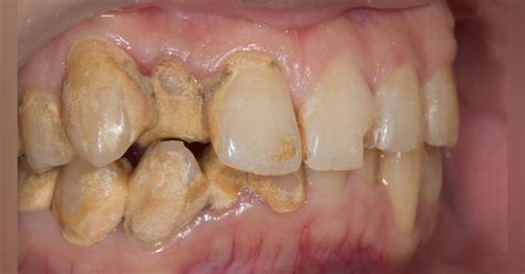 Calculus bridge: Do your patients know the risks? | Dentistry IQ