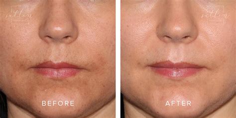 Melasma Treatment | Vancouver | West Dermatology