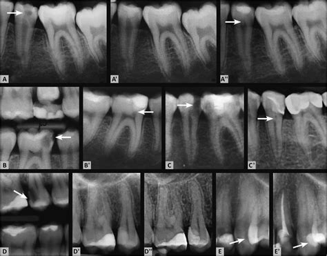 (A) The preoperative periapical radiograph shows a deep carious lesion... | Download Scientific ...