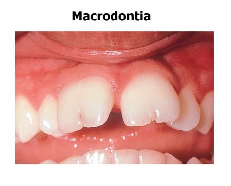 All you need to know about macrodontia | News | Dentagama