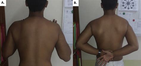 No Right Winged Scapula 6 months after surgery. | Download Scientific ...