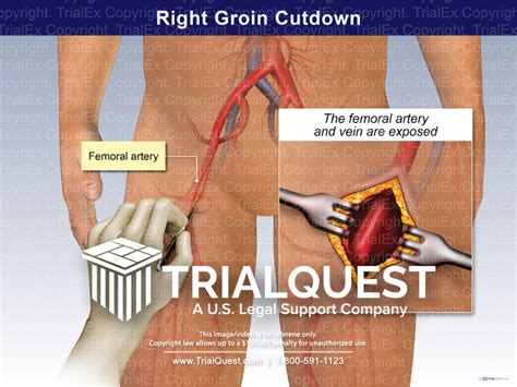 Right Groin Cutdown - TrialQuest Inc.