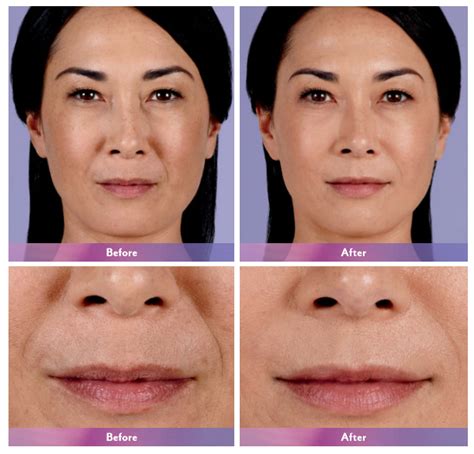 Secret Weapon to Fighting Signs of Aging: Dermal Fillers - Dy Dermatology Center