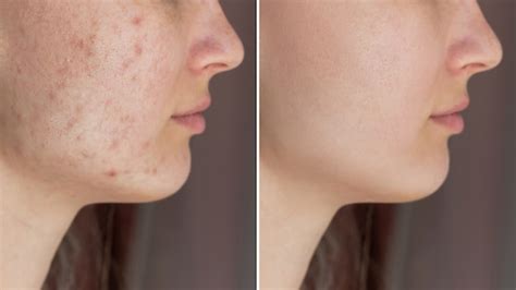 Acne before after Images - Search Images on Everypixel