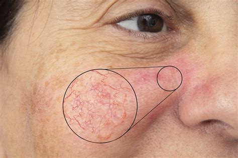 Broken Capillaries – Cause and Treatment | Ask a Dermatologist