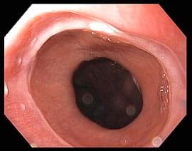 Webs, Rings & Diverticula | MUSC Health | Charleston SC