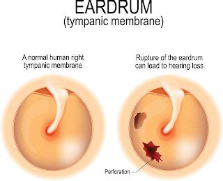 Ear Drum Perforation Surgery