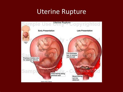 PPT - Obstetric Hemorrhage PowerPoint Presentation, free download - ID:1944104