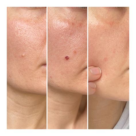 [Review] Electro-Cauterization treatment to remove sebaceous hyperplasia : r/SkincareAddiction