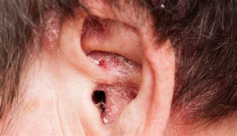 Ear Eczema: Symptoms, Causes & Treatment